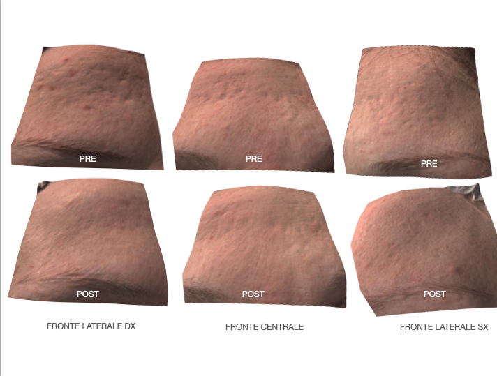 risultati di dermochirurgia correttiva e laser dell'acne cicatriziale