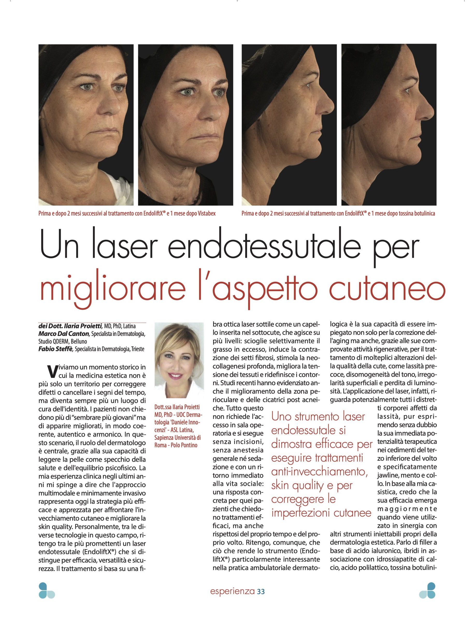 il dr. Marco Dal Canton, co. autore, con la dr.ssa Ilaria Proietti (Univ, La Sapienza - Roma) e il dr. Fabio Steffè (Trieste) di una pubblicazione su EndoliftX, laser a fibra interstiziale 1470 nm per la cura della pelle.